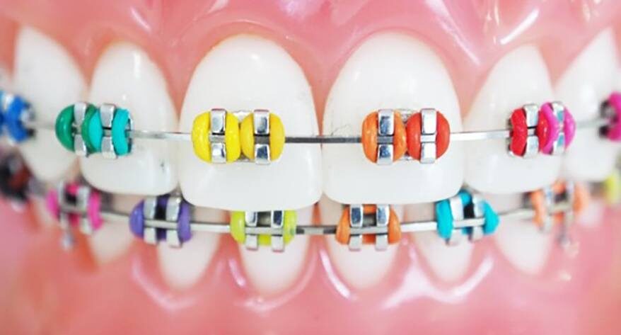 How Traditional Braces Work