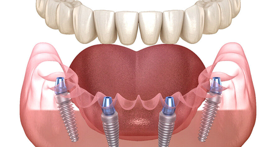 Implant Dentures