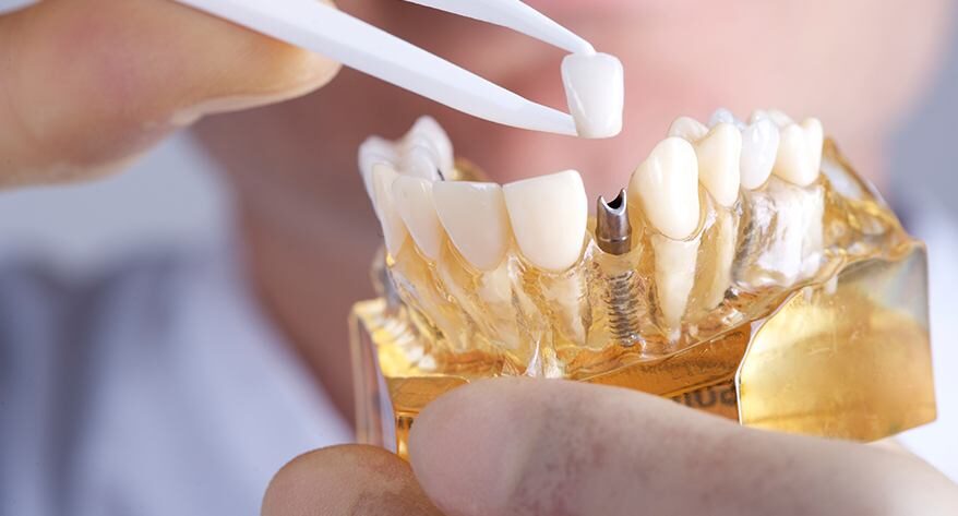 What is a Dental Implant