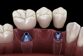 Implant Solutions for Every Need