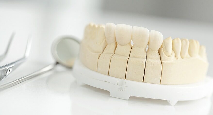 Dental Bridges