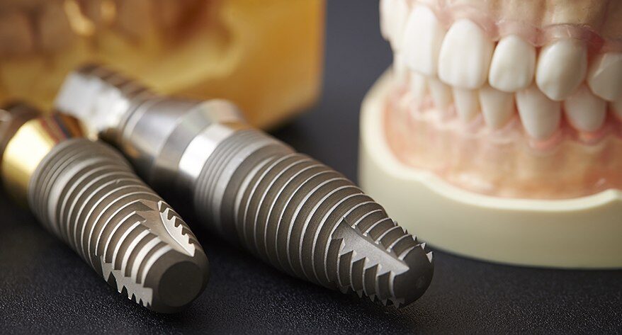 Dental Implants