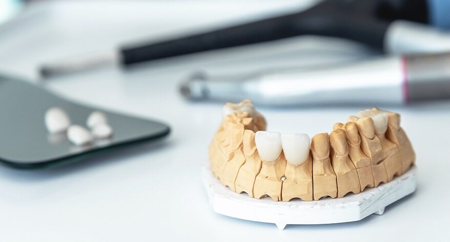 Dental Crowns